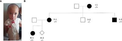 Familial and genetic association with neurodevelopmental disorders caused by a heterozygous variant in the SRRM2 gene